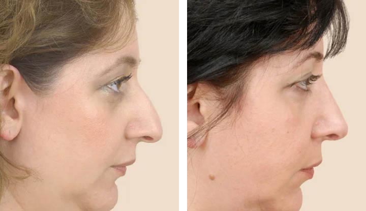 Rhinoplasty Procedure