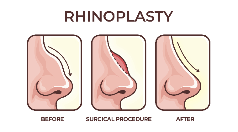 Rhinoplasty Procedure