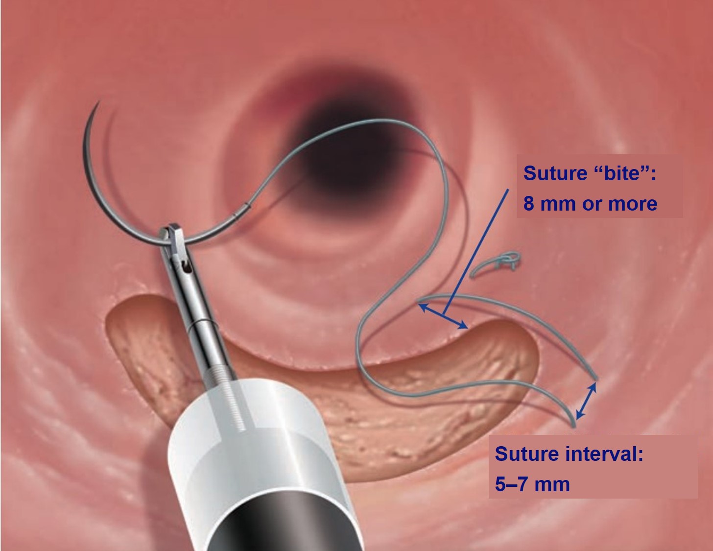 Rhinoplasty Procedure
