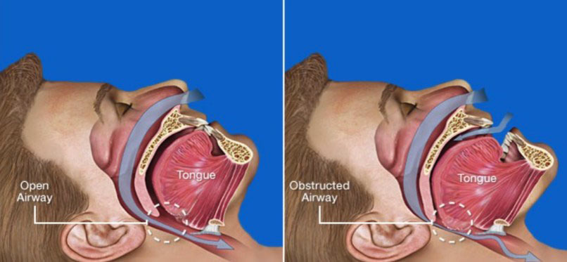 Treatment For Snoring
